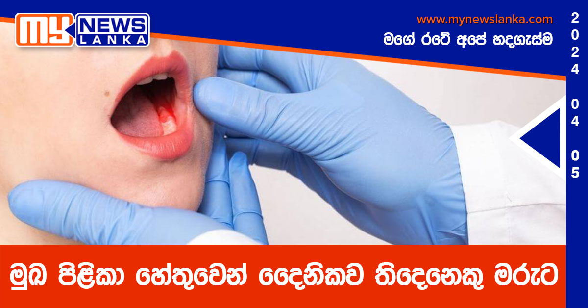 මුඛ පිළිකා හේතුවෙන් දෛනිකව තිදෙනෙකු මරුට මුඛ පිළිකා හේතුවෙන් දෛනිකව තිදෙනෙකු මරුට